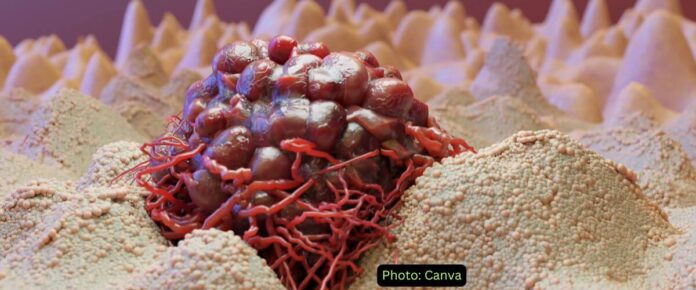 Campylobacter jejuni Toxin Linked to Colorectal Cancer Metastasis