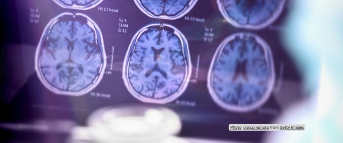 How Hyperconnectivity Fuels Tau Spread in Alzheimer’s Disease?