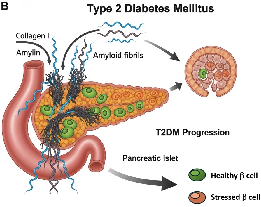 Sticking to Trouble Tissue Scaffolds Accelerate Amyloidogenesis and Disrupt Glucose 2Homeostasis