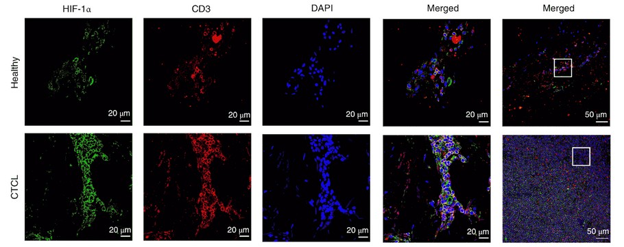 Figure - IL-9 and the Secret Behind Cancer Cell Dissemination