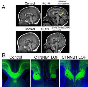 How β-CATENIN helps to wire the brain’s largest communication bridge