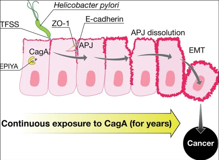 From Ulcers to Cancer The Story Behind the Discovery of a Bacterial Cancer Protein