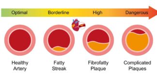 Gut Microbiome Molecule ImP Linked to Atherosclerosis and Heart Disease Risk Gut Microbiome Molecule ImP Linked to Atherosclerosis and Heart Disease Risk