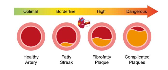Gut Microbiome Molecule ImP Linked to Atherosclerosis and Heart Disease Risk