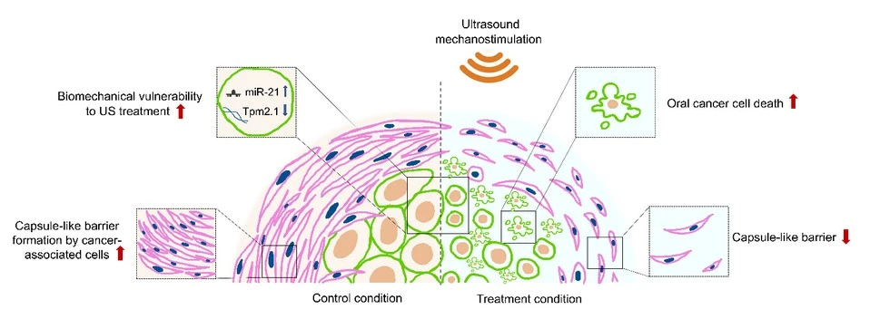 Using ultrasound to selectively kill oral cancer cells 